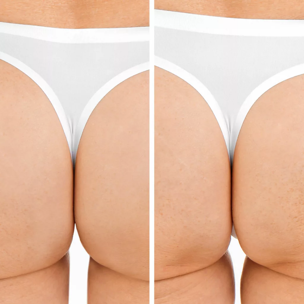 before and after emsella treatments for urinary incontinence
