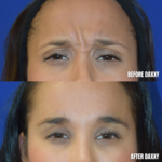 before and after comparison of patient with daxxify injectable fillers to address severe wrinkles