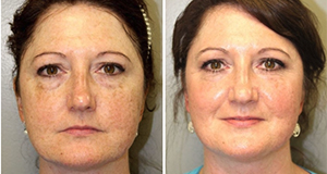 Artemedica client before and after CoolPeel
