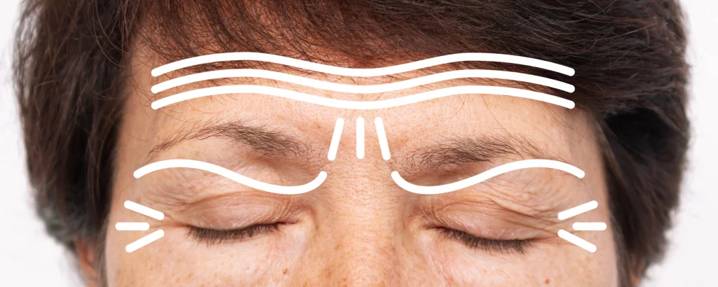 diagram of problems a brow lift addresses such as wrinkles around the brows and eyes