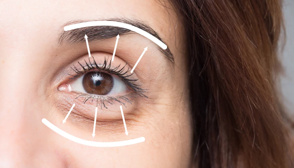 diagram of problems eyelid surgery addresses such as sagging or drooping eyelids