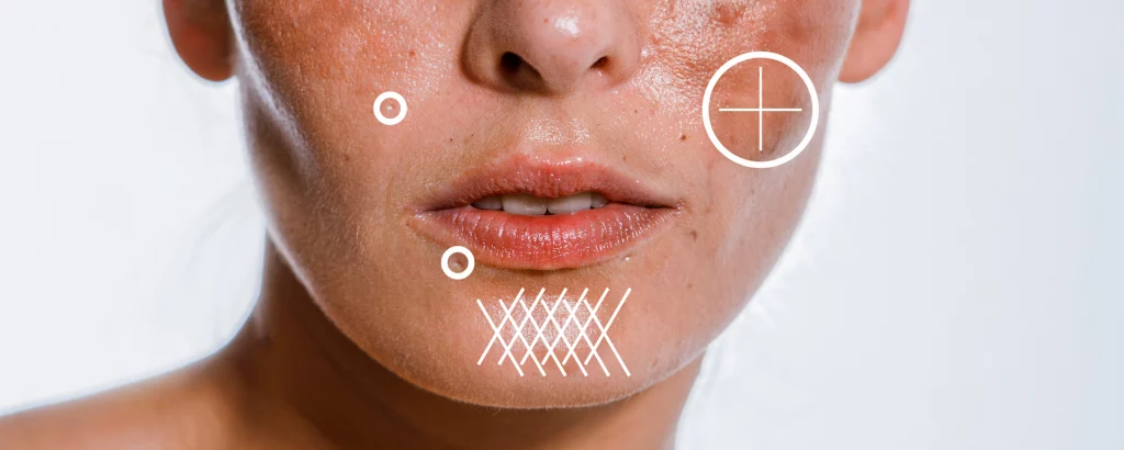 diagram of skin conditions laser resurfacing can address such as acne scars, hyperpigmentation and enlarged pores