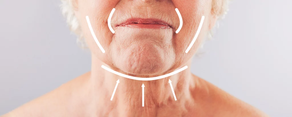 diagram of problems a neck lift addresses such as sagging skin around the chin, jaw and mouth