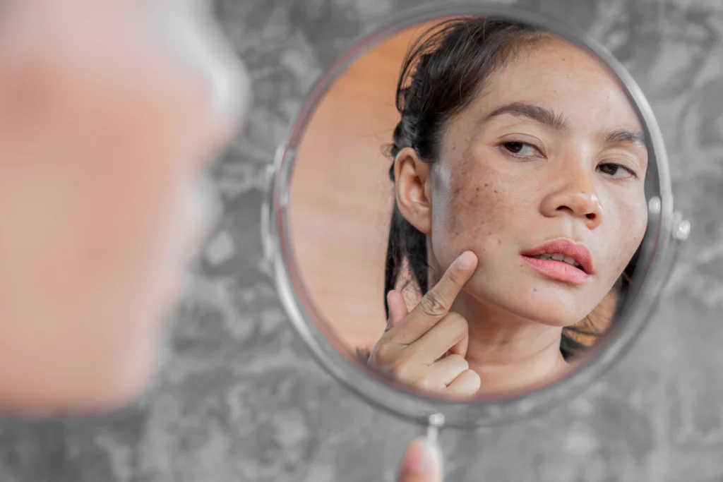 asian woman inspecting her hyperpigmentation and uneven skin tone in the mirror