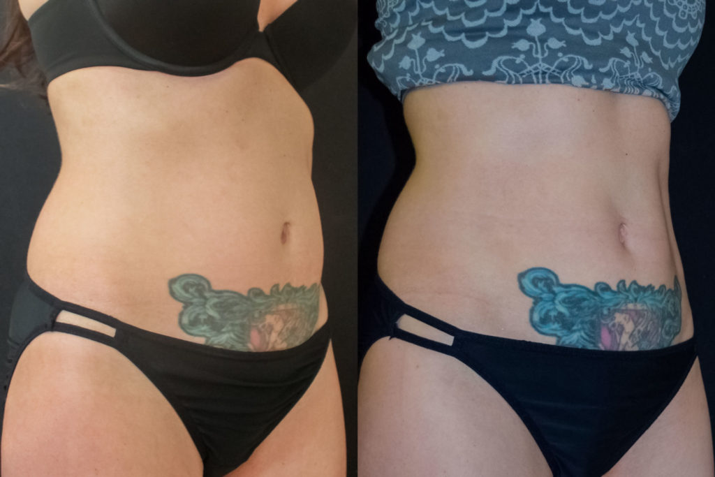 before and after coolsculpting at artemedica