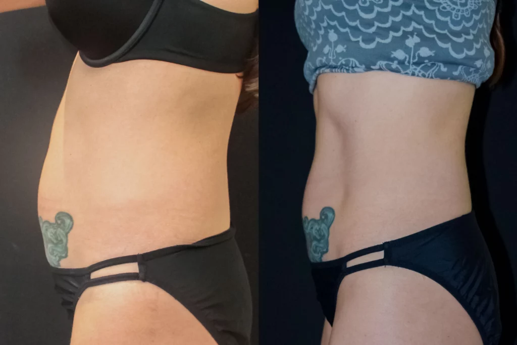 before and after coolsculpting at artemedica