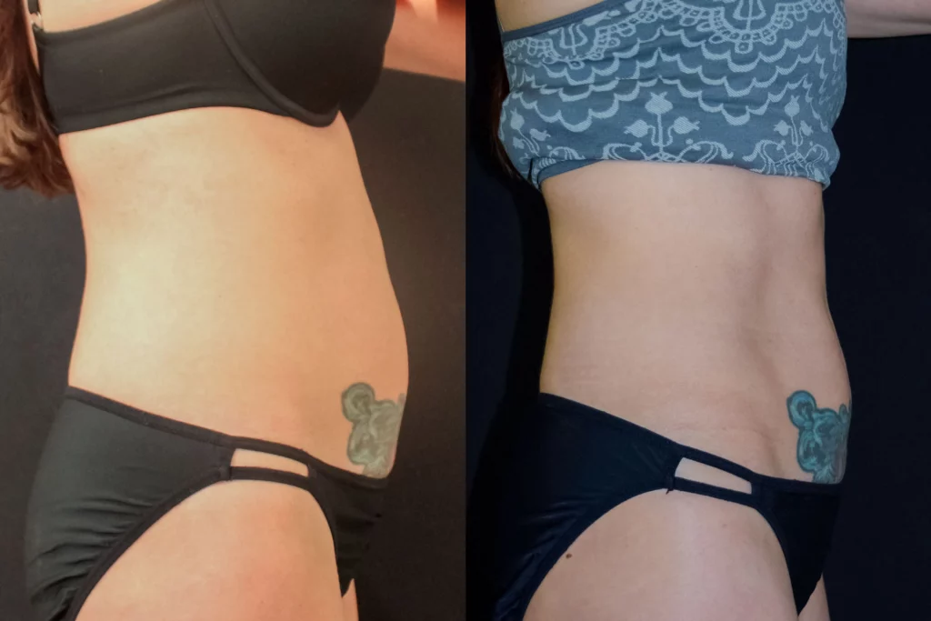 before and after coolsculpting at artemedica