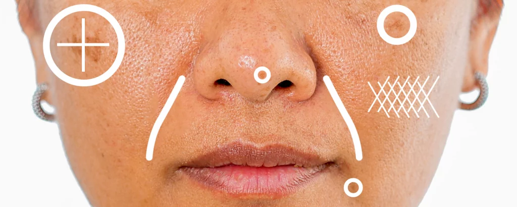 diagram of problems Clear + Brilliant laser skin treatments addresses including fine lines, enlarged pores, and melasma