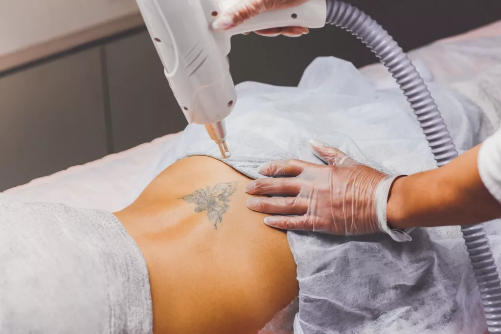 young woman undergoing laser tattoo removal for a tramp stamp on her lower back