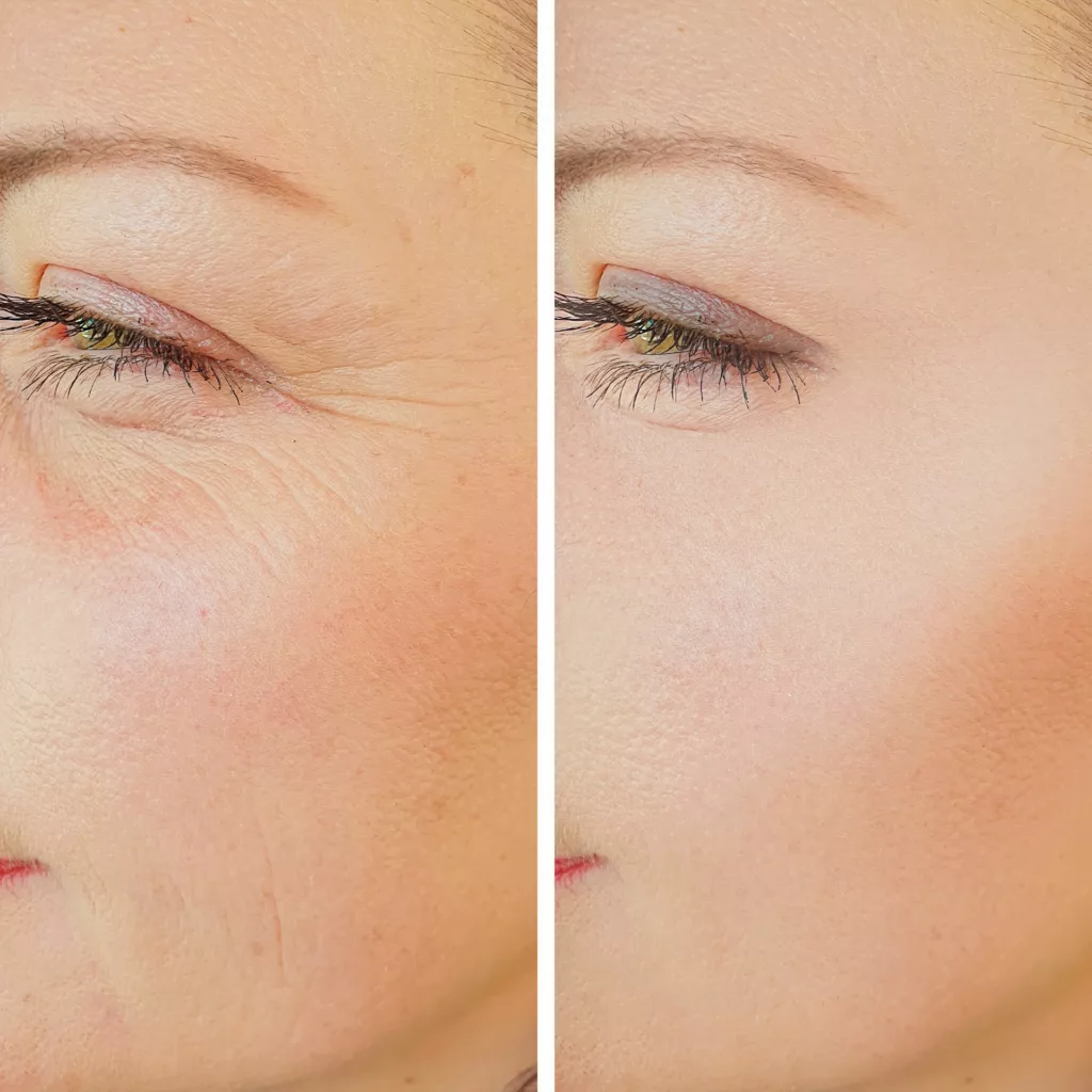 before and after prp fillers