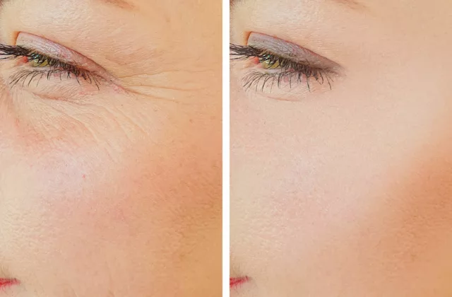 before and after prp fillers