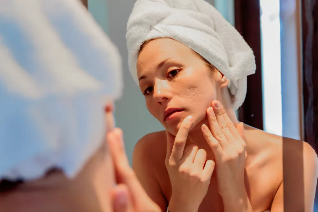 a young woman examines the pervasive acne scarring and pock marks on her cheek