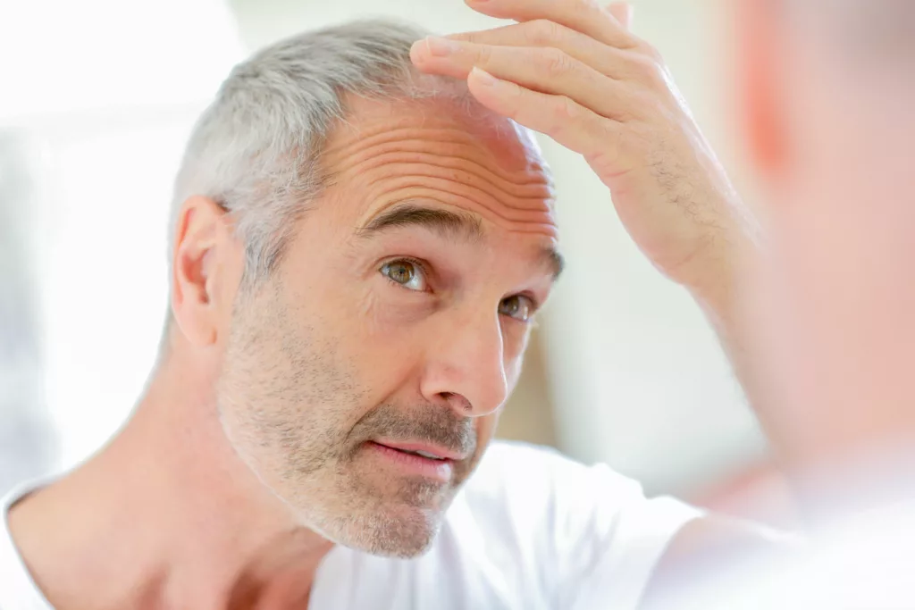 mature man examines his receding hairline and thinning hair on the top of his head