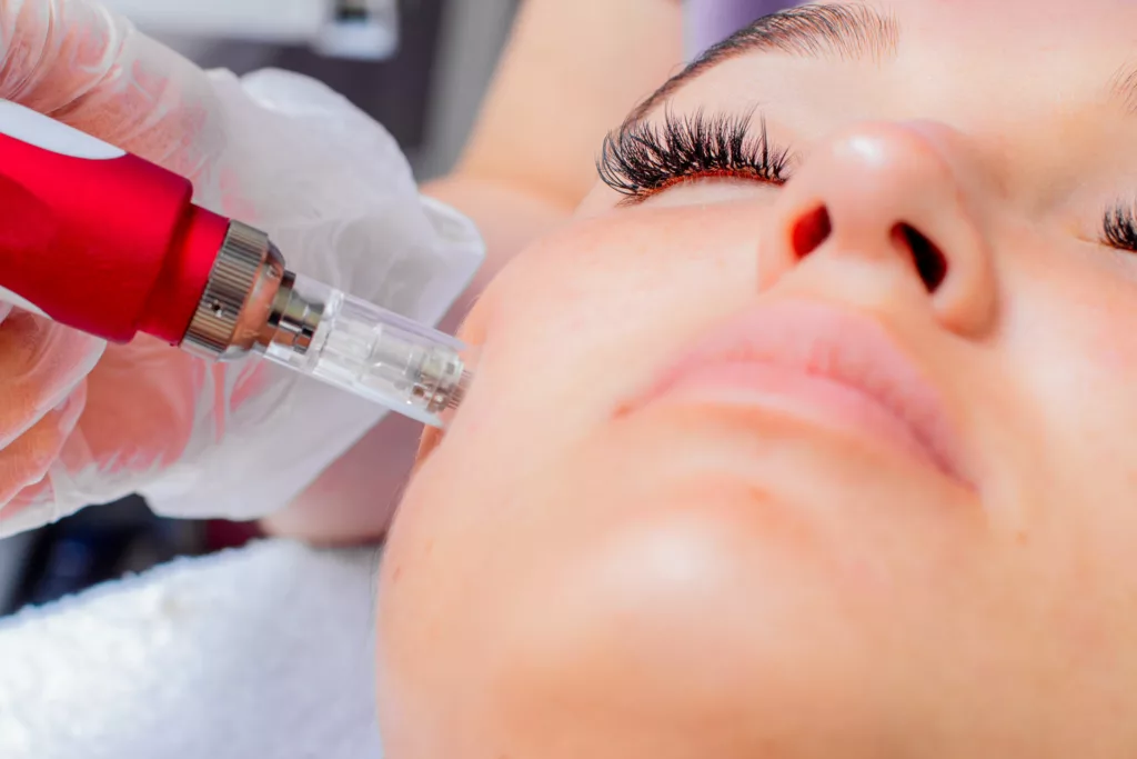 young woman receiving vivace microneedling treatment on her cheeks