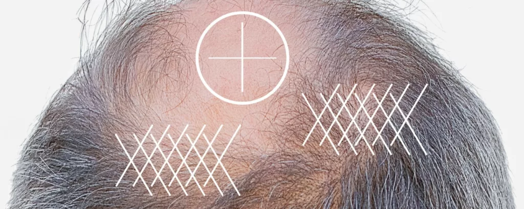 diagram explaining what prp hair restoration addresses including hair thinning, loss and baldness