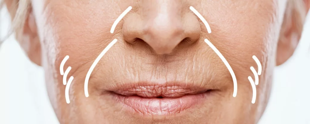 diagram of what PRP fillers address including fine lines, wrinkles, bags under the eyes and acne scarring
