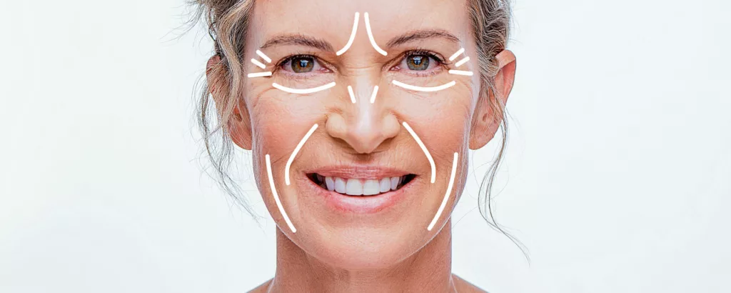 diagram highlighting what BOTOX can address on the face including crow's feet, glabellar lines, bunny lines and other fine lines and wrinkles