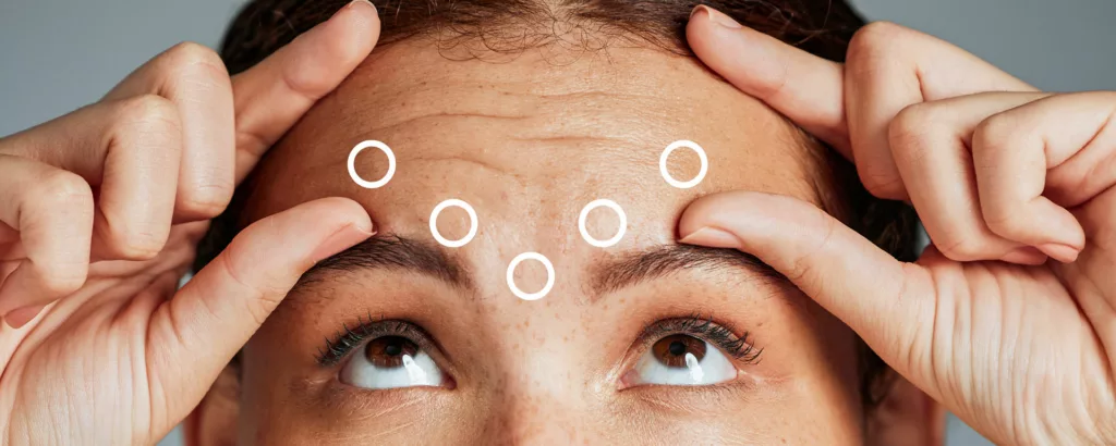 diagram of 5 injection points above and between the eyebrows