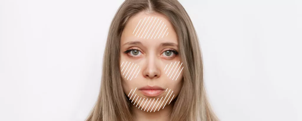 diagram highlighting what areas emface can treat including the cheeks, forehead, eyebrows and jaw