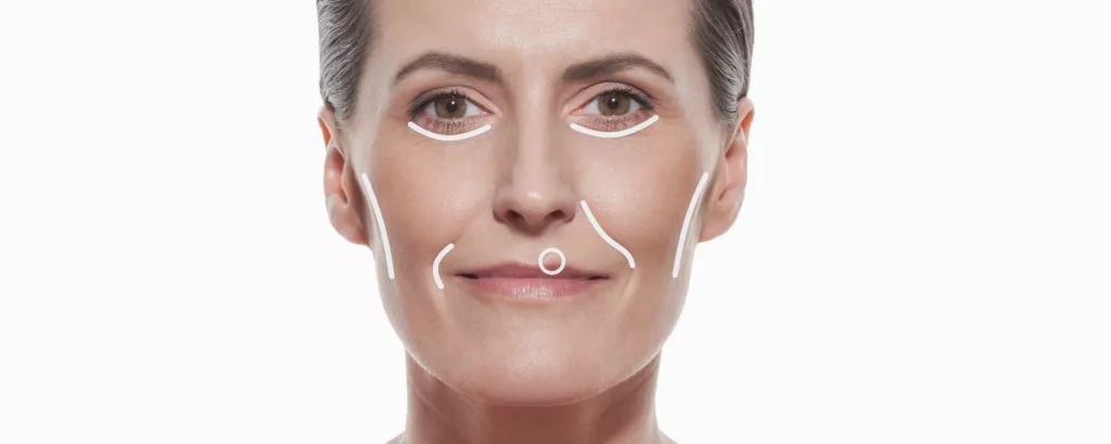 diagram of conditions juvederm ultra addresses like wrinkles, fine lines, nasolabial folds, and thin lips