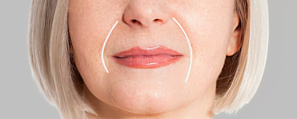 diagram of cosmetic conditions Juvéderm Vollure XC dermal fillers treat like laugh lines