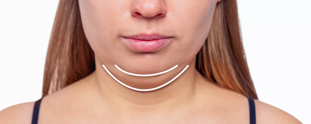 diagram highlighting what Kybella treats including significant fullness under the chin (double chin) due to excess fat accumulation