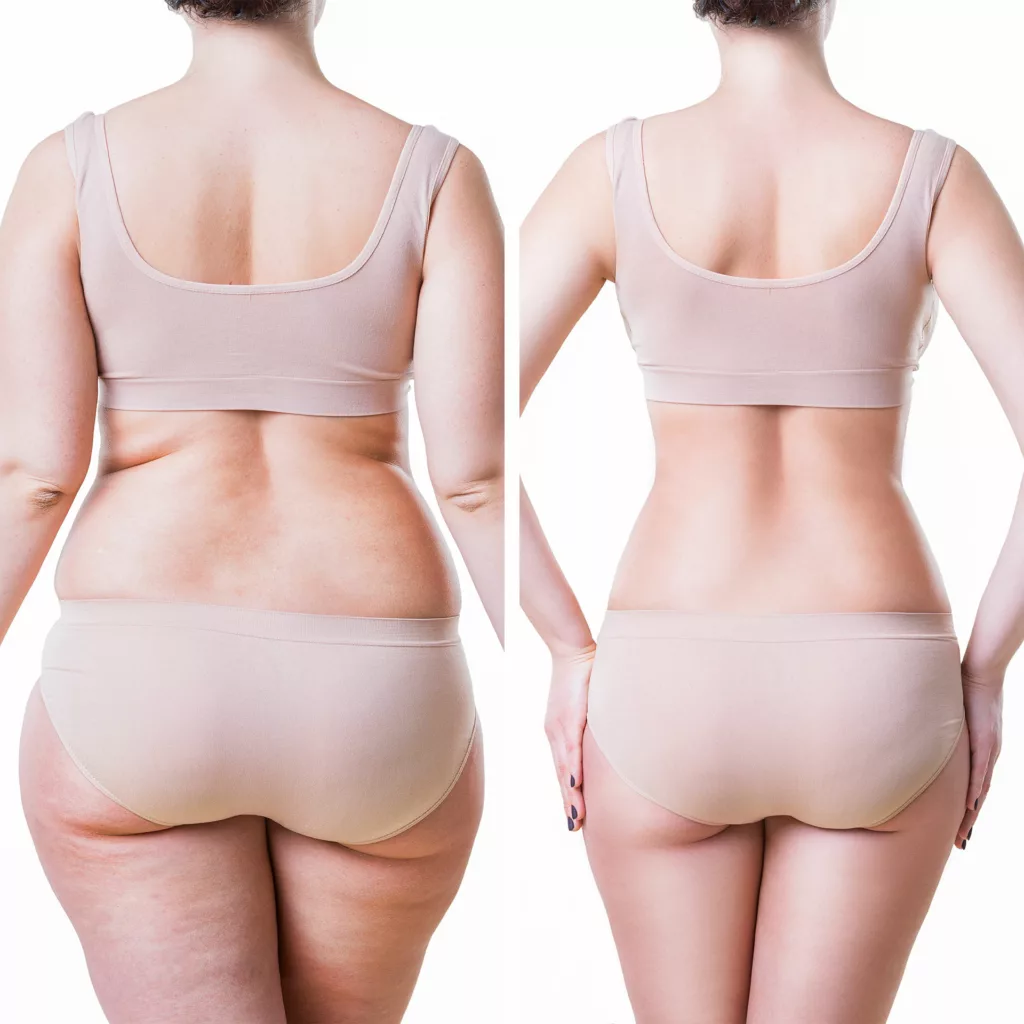 before and after semaglutide injections to lose weight