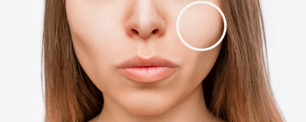 diagram explaining what areas of the face restylane contour treats including the cheeks