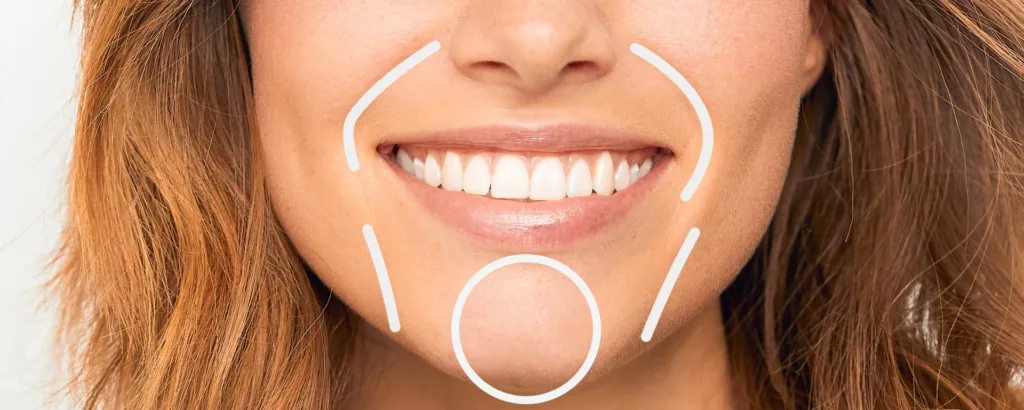 diagram showing what restylane defyne injections treat like deep nasolabial folds, marionette lines and a recessed chin