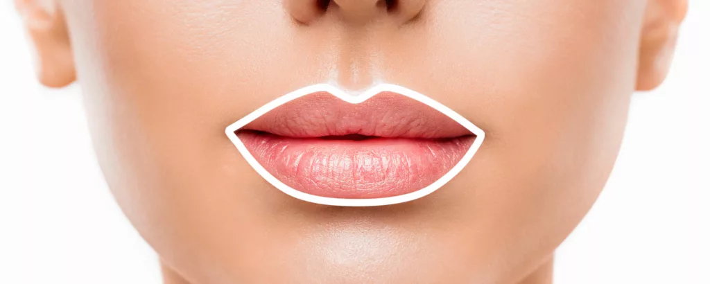 diagram showing what restylane kysse injections treat such as increasing lip volume, color and improving texture