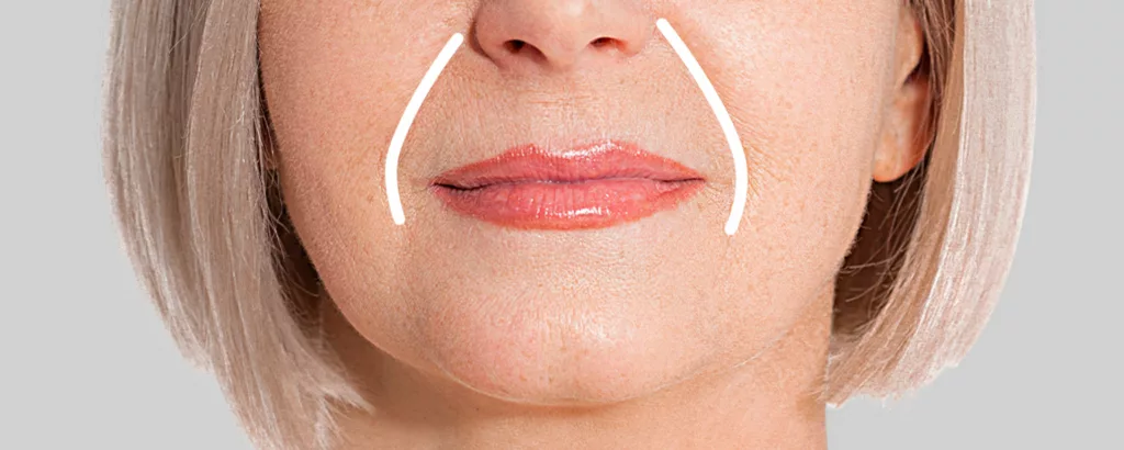diagram showing what restylane refyne is effective in treating including nasolabial folds (aka smile or laugh lines and marionette lines)