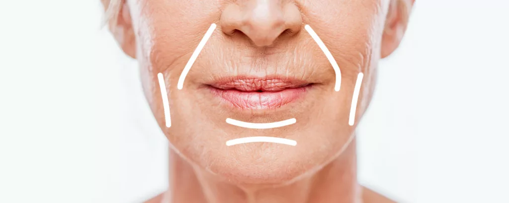 diagram showing what Sculptra injections can treat like wrinkles and folds as well as stimulate collagen production