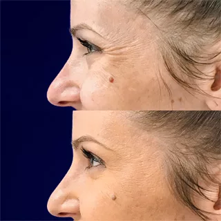 before and after BOTOX injections at Artemedica