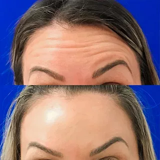 before and after BOTOX injections at Artemedica