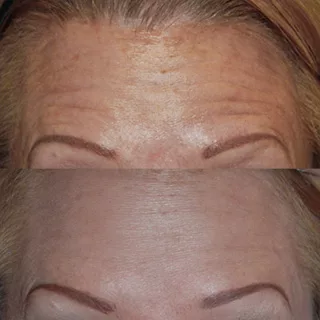 before and after BOTOX injections at Artemedica