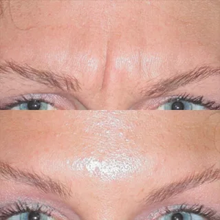 before and after BOTOX injections at Artemedica