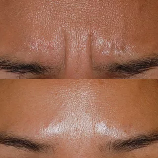 before and after BOTOX injections at Artemedica