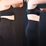 before and after comparison of a real patient after skinny shot injections at artmedica