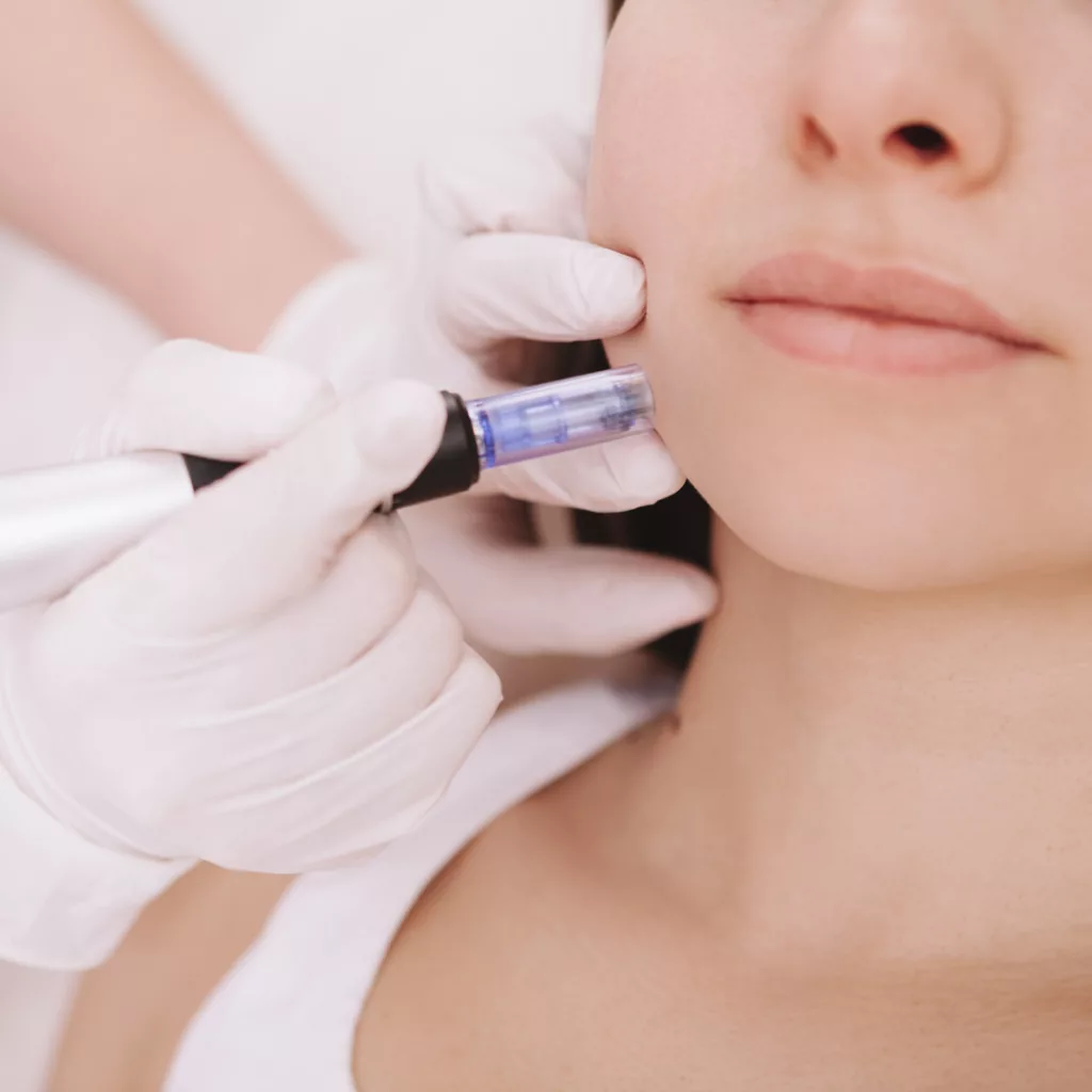 closeup of woman getting microneedling service from a licensed esthetician