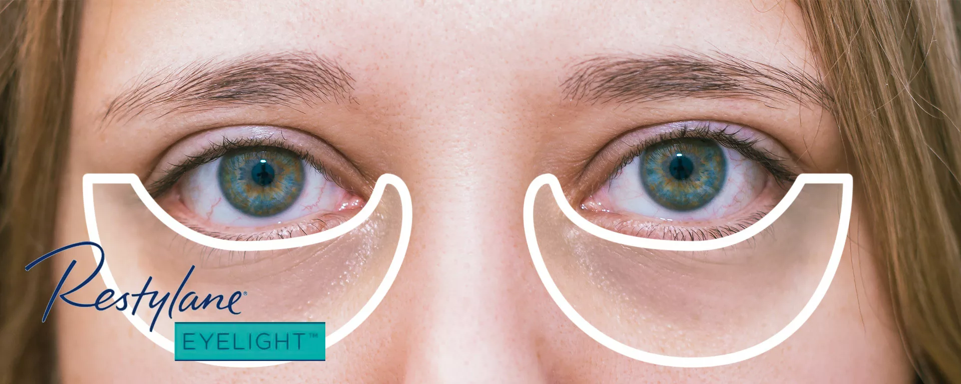 Under Eye Fillers - Before & After Results at Skinly