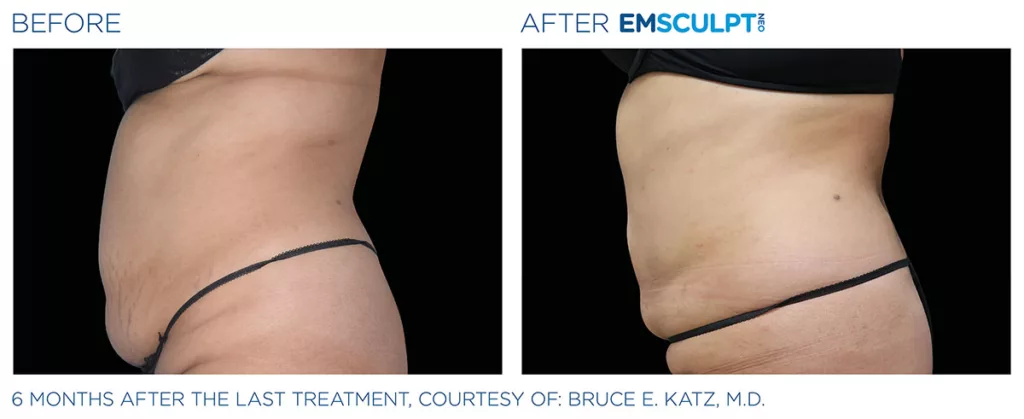 A before and after photo shows someone's abdomen after Emsculpt NEO treatment.