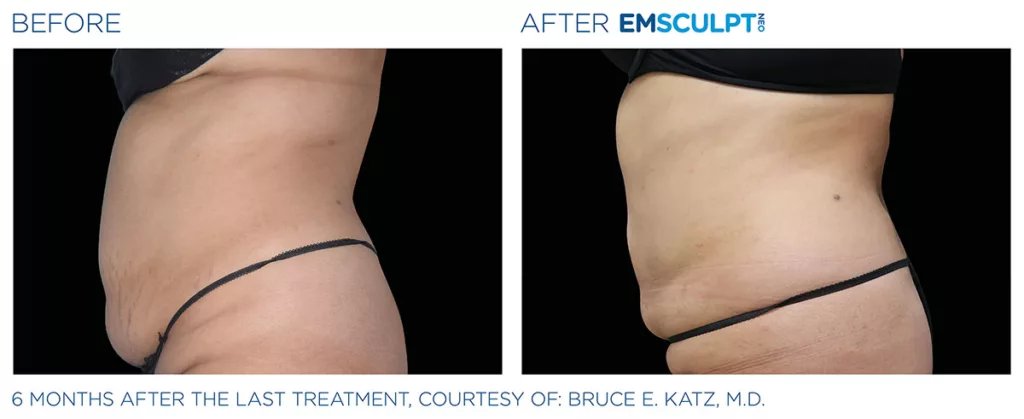 All about stomach liposuction for a perfectly sculpted abdomen