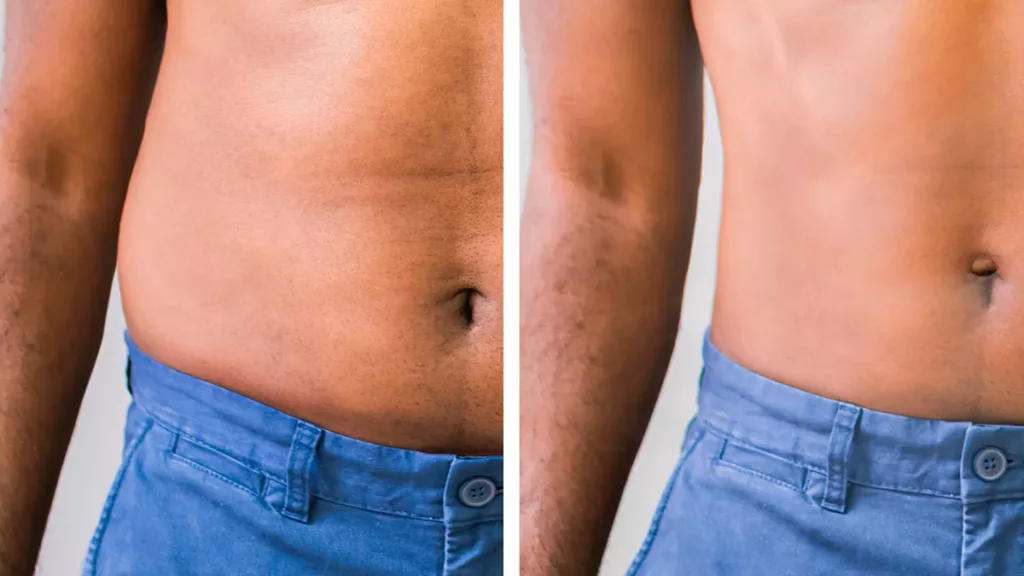 Before and after photos show a person's abdomen after Coolsculpting Elite treatment on belly fat.