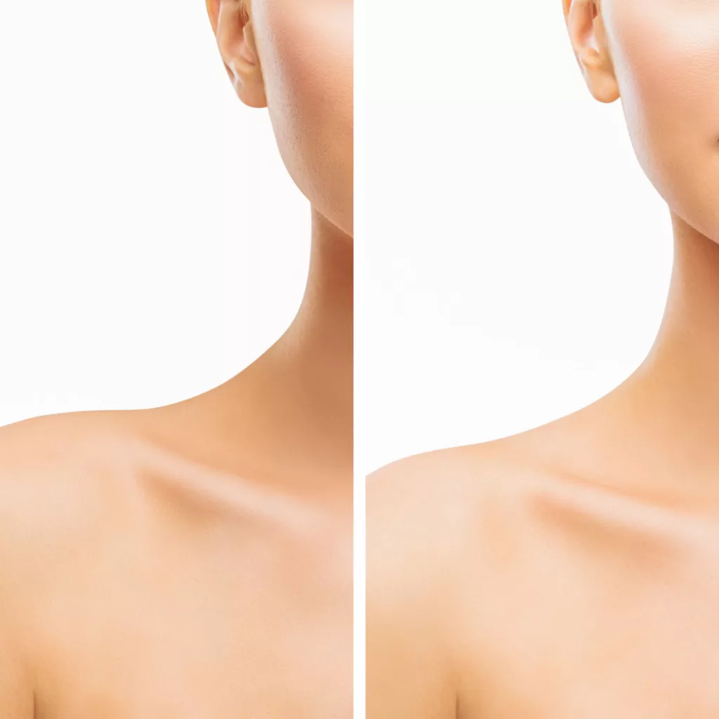 before and after trap botox for a longer, slimmer neck and better-defined shoulders
