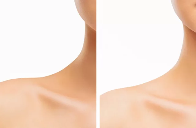 before and after trap botox for a longer, slimmer neck and better-defined shoulders