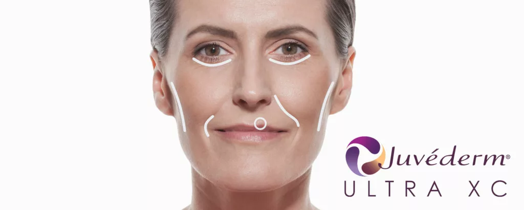 diagram of areas and skin concerns that can be treated with juvederm ultra