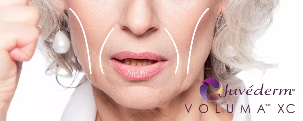 juvederm voluma is used to correct sunken or hollow cheeks as seen in this diagram