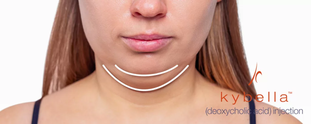 diagram highlighting what Kybella treats including significant fullness under the chin (double chin) due to excess fat accumulation