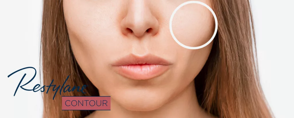 diagram explaining what areas of the face restylane contour treats including the cheeks
