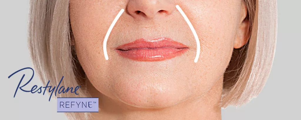 diagram showing what restylane refyne is effective in treating including nasolabial folds (aka smile or laugh lines and marionette lines)